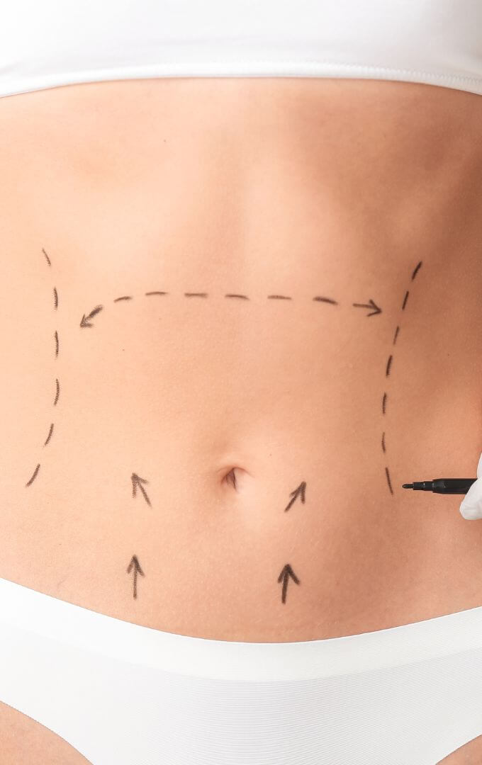 abdominoplastik